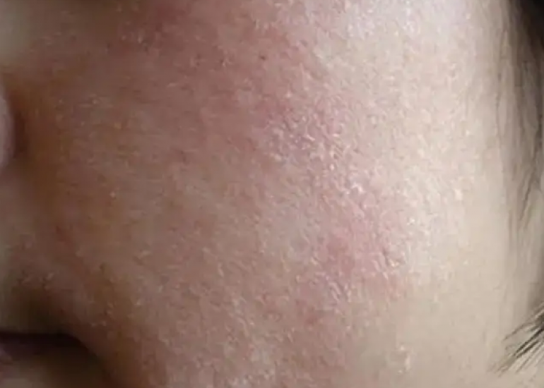 【獨生美】618好物就在視頻號 皮膚換季敏感拯救夏季干皮 懶人專用護膚品